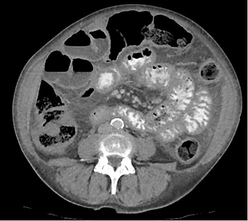 Axial CT image displaying diffuse thickening of the small and large bowel with dilatation of the small bowel.