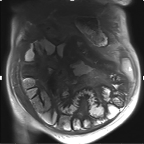 Coronal magnetic resonance image of abnormal thick-walled loops of jejunum and proximal ileum without focal stricture.