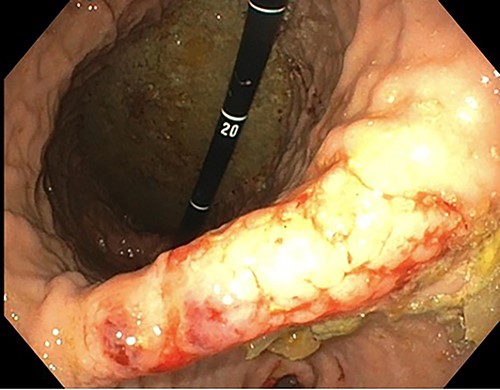 Endoscopic retroflexed view of the stomach showing gastritis, patchy telangiectasia and sloughy mucosa at the incisura.