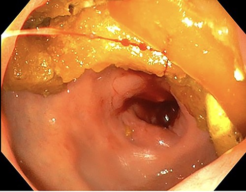 Endoscopy showing duodenitis with stricture at the second part of duodenum (D2).