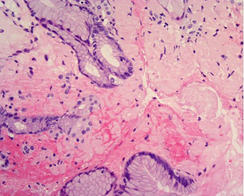 High power of proximal jejunum biopsy showing extensive submucosal deposition of pink amorphous material (H&E ×20).