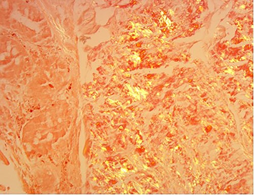 Amyloid stain on proximal jejunum biopsy as seen under polarized light showing apple-green birefringence (Congo Red ×20).