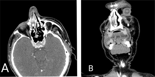 Computed tomography scan of the head. (A) Axial view and (B) coronal view demonstrating mass lesion in the right nasal cavity attached to the septum measuring 1 × 1.5 cm.
