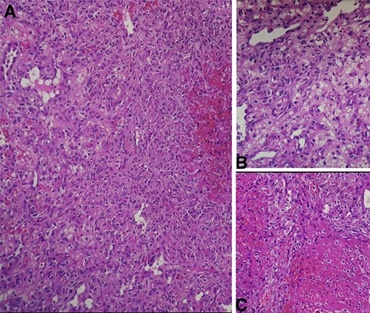 (A) Intermediate-power field (×20) shows marked nuclear atypia and pleomorphism. (B) High-power field (×40) shows proliferation of atypical spindle cells with atypical mitotic figures (C) High-power field (×40) shows focal areas of necrosis.