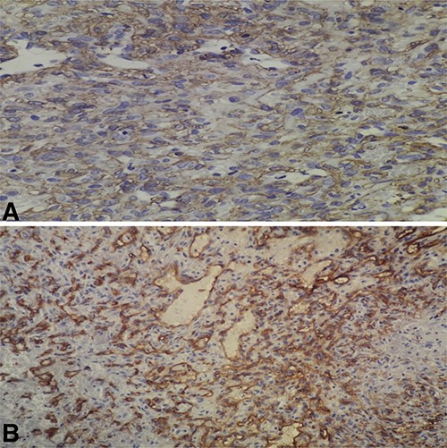 (A) High-power field (×40) shows immunoreactivity for SMA; (B) high-power field (×40) shows focal immunoreactivity for CD34.