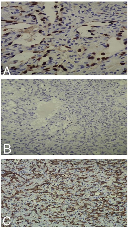 (A) Intermediate-power field (×20) shows negative ERG staining by the tumor cells. (B) Intermediate-power field (×20) shows negative S100 staining by the tumor cells. (C) Intermediate-power field (×20) shows negative CD31 staining by the tumor cells.