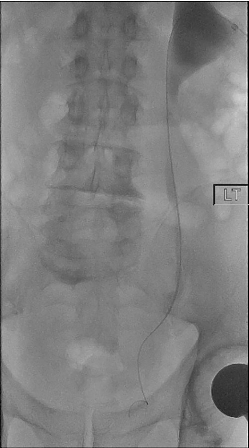 Antegrade left nephrostogram demonstrating left VUJ hold up.