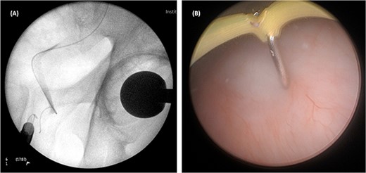 A combined visual- and x-ray-guided approach verified the exact location of the course of the intravesical intramural right ureter, in correlation to the resectoscope. (A) X-ray, (B) cystoscopic view.