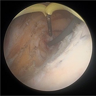 Cystoscopic view of exposed left VUJ with identification of terumo guidewire passed antegradely.