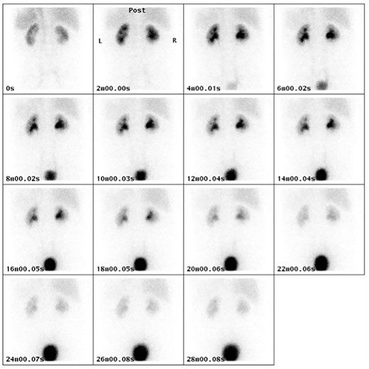 MAG3 renogram at 4 months post-operatively demonstrating normal uptake and excretion pattern in both kidneys.