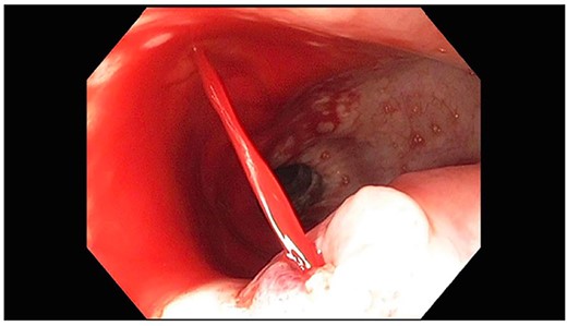 EGD showing actively spurting blood from midesophageal ulcer.
