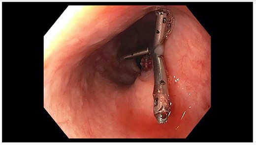 Repeat EGD showing three clips from prior EGD; no evidence of active bleeding.