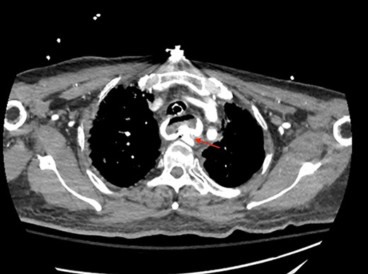 CT thoracic angiogram showing actively bleeding aberrant right subclavian artery perforating into the esophagus (red arrow).