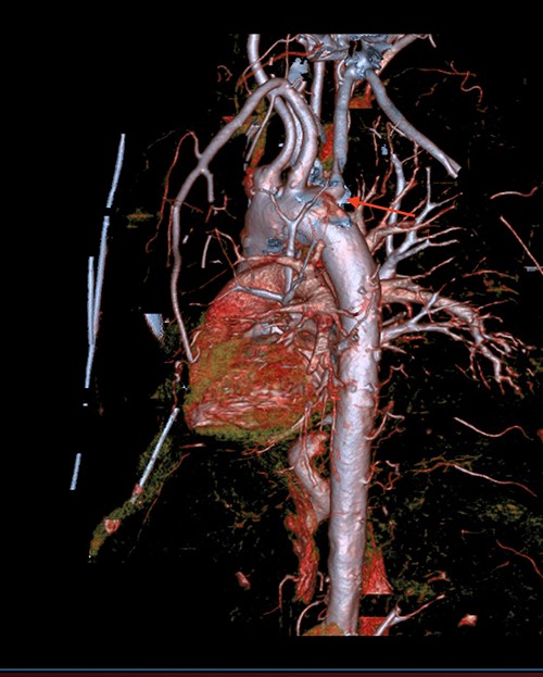 CT thoracic showing the arch of the aorta with the take-off of the right subclavian artery (red arrow) distal to the left subclavian artery.