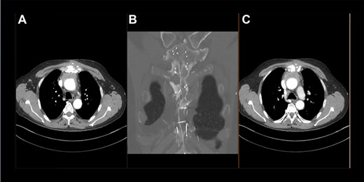 Preoperative thoracic CT scan; (A) image indicates the sternal defect caused by osteomyelitis and the infected hematoma surrounding the native aortic arch; (B) topogram indicating the sternal defect caused by osteomyelitis in coronary sectional plane; (C) image indicates the sternal defect caused by osteomyelitis and the infected hematoma surrounding the aortic prosthesis.