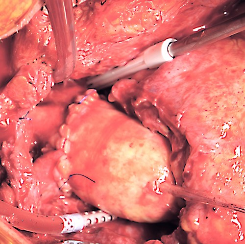 Intraoperative photograph demonstrating the surgical result after homograft replacement of the ascending aorta and aortic hemiarch.