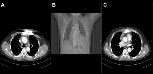 Post-operative thoracic CT scan; (A) chest wall reconstruction in transverse sectional plane; (B) topogram showing sternal wires and titanium plate arrangement; (C) chest wall closure and aortic homograft with small seroma collection in transverse sectional plane.