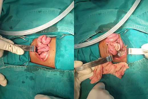 Intestinal fluid leaking into peritoneal cavity, with change in color of the proximal jejunum.