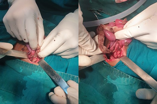 Necrosis of the jejunum and whole length of duodenum with detached mesentery.