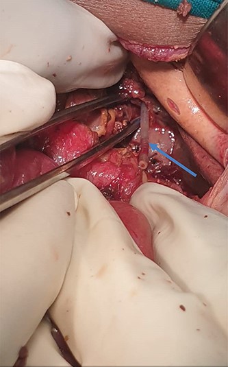 Orogastric tube seen at the abdominal end of the esophagus. (blue arrow).