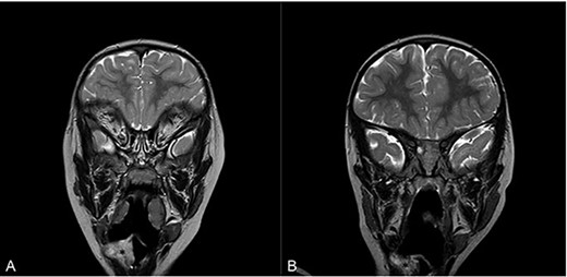 Magnetic resonance imaging (MRI) of head and neck with contrast in sagittal view on admission (A) and at 16 months follow-up (B). Asterisk denotes area of interest.