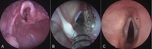Intraoperative endoscopic images of the supraglottis: (A) before intervention; (B) after debridement; and (C) at 16 months after surgical intervention. Asterisk denotes area of interest.