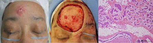 Enlarged resection of case1 and the pathological findings.