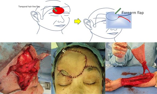 Intraoperative findings of case1 using a temporal hairline flap combined with a free forearm flap.