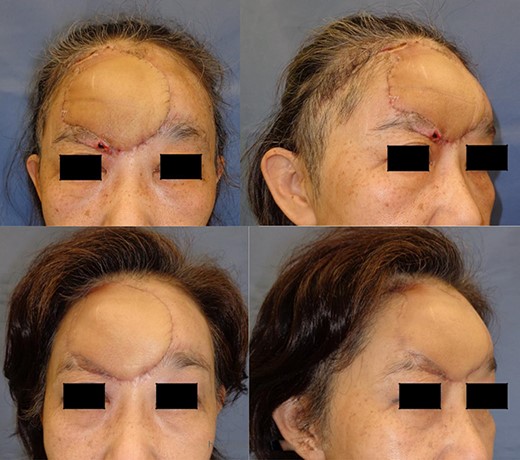 The condition at 8 weeks after surgery of case1 with no touch-up procedures is shown.
