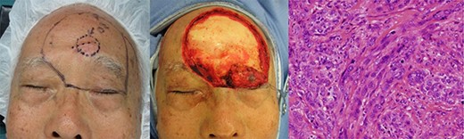 Enlarged resection of case 2 and the pathological findings.