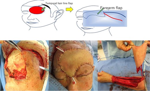 Intraoperative findings of case 2 using a temporal hairline flap combined with a free forearm flap.