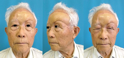 The condition at 1 year after surgery of case 2 with no touch-up procedures is shown.