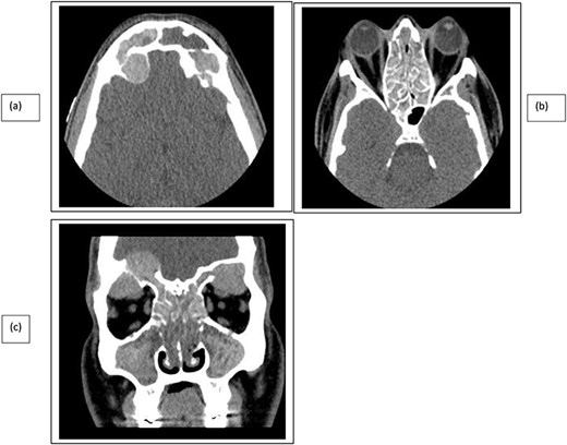 CT paranasal sinuses axial (a, b) and coronal (c) show sinus expansion, bony remodeling and dehiscence with intra-orbital and intracranial extension. Bilateral orbital proptosis.