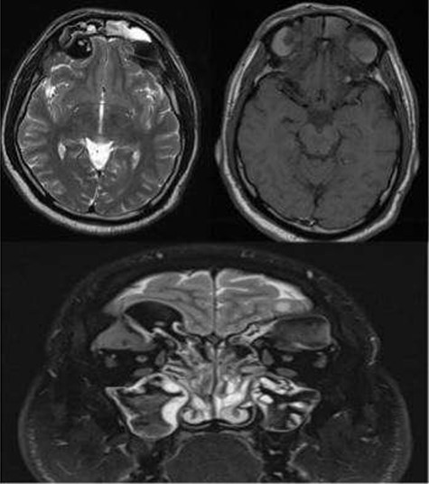 MRI paranasal sinuses axial and coronal T2 and axial T1 The MRI shows the expansion with the remodeling of the sinuses and intra-orbital/intracranial extension. The hyperdense contents show marked low signal intensity on T2 and high T1 signal. No tissue invasion of the orbital or brain parenchyma.