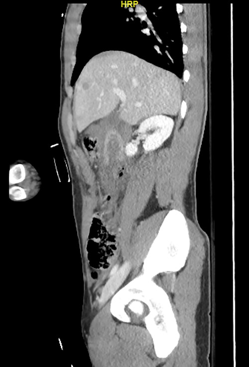 Pre op CT sagittal.