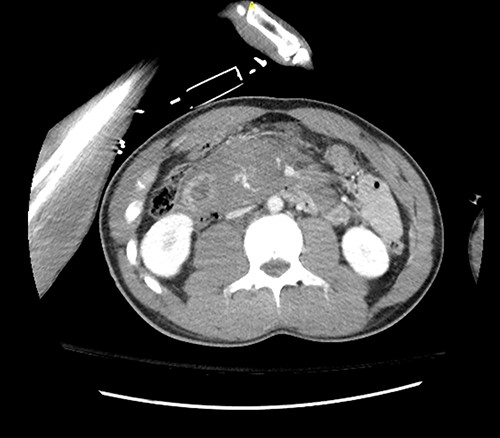 Pre op CT axial.