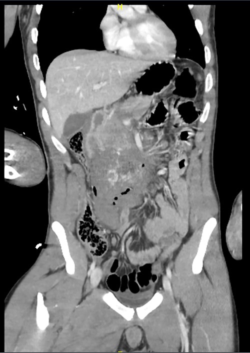 Pre op CT coronal.