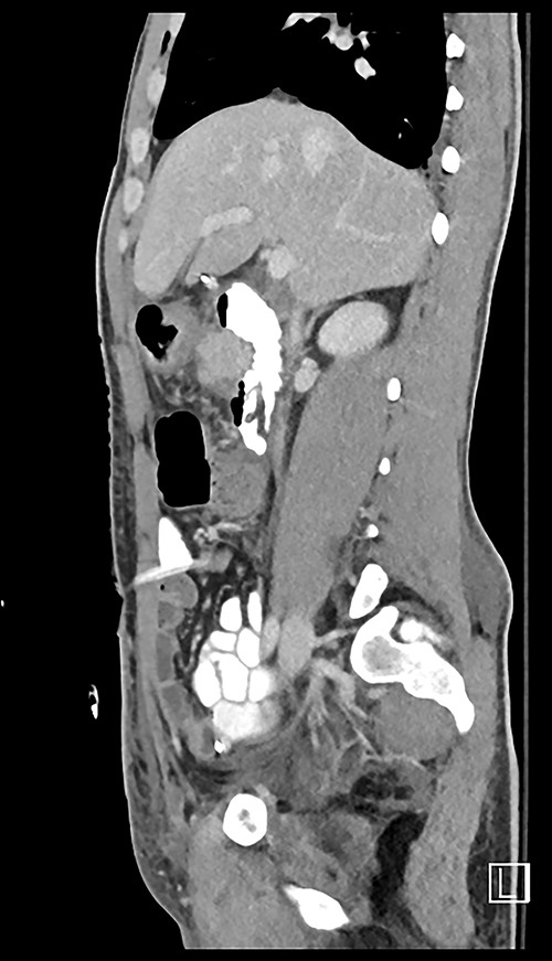 Post op CT sagittal.