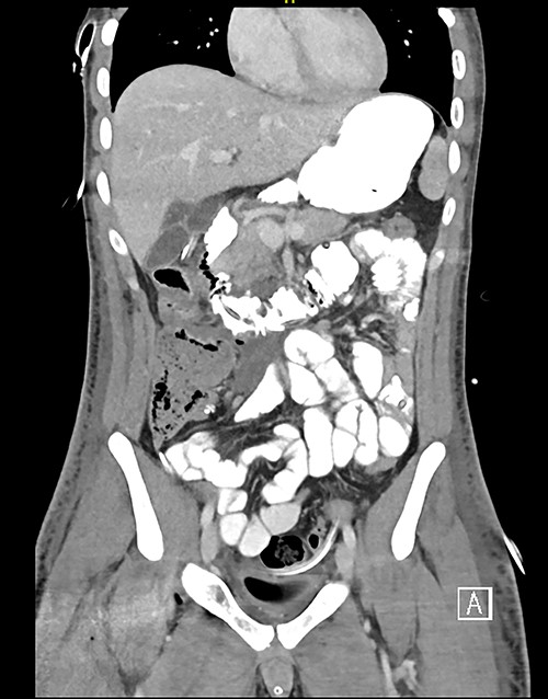 Post op CT coronal.
