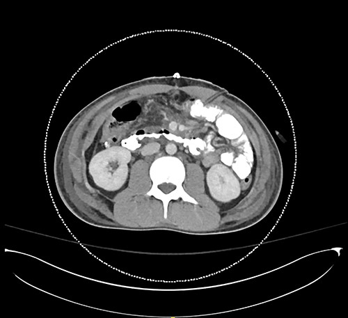 Post op CT axial.