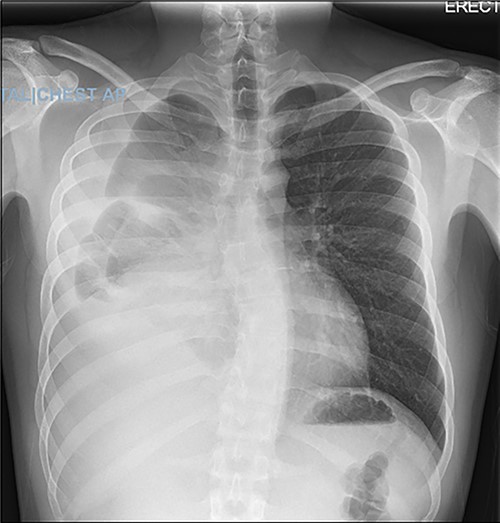 Chest X-ray demonstrating large right pleural effusion.