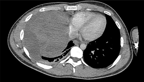 Axial view of CT of thorax with intravenous contrast demonstrating large enhancing and heterogenous mass of the right hemithorax; right-sided pleural effusion is also seen.
