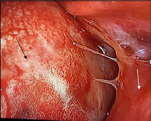 Intraoperative image with patient in left lateral decubitus position demonstrating the mass (black arrow) causing compression of the lung (white arrow).