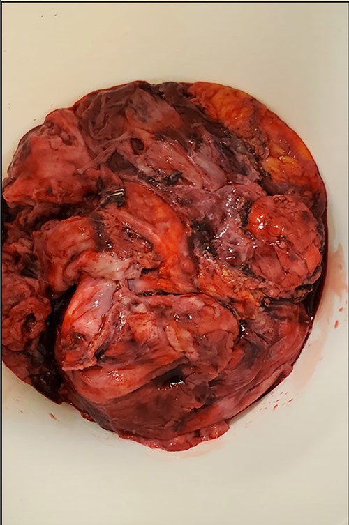 Entirety of the resected mass.