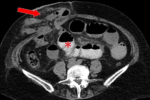 Axial CT scan with oral contrast demonstrating right-sided parastomal hernia containing small bowel loops (arrow) and proximal small bowel dilatation (asterisk).