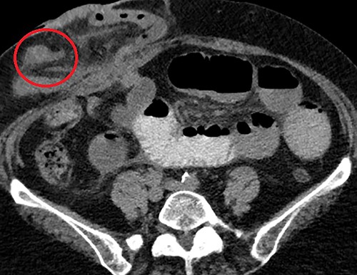 Axial CT scan demonstrating the MD (circled) arising from the anti-mesenteric aspect of the ileum within the parastomal hernia, identified after close retrospective review of imaging post operatively.