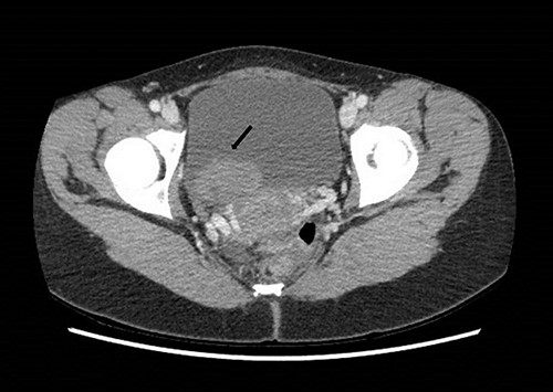 Computed tomography on presentation showing a bladder mass (arrow).