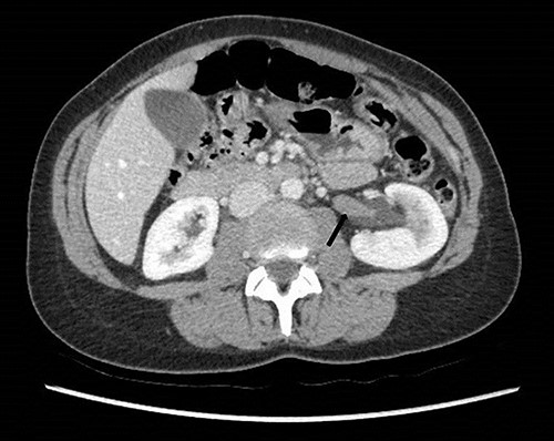 Computed tomography on presentation showing the hypodense filling defect extending from the left renal pelvis to the proximal ureter with associated hydronephrosis (arrow).