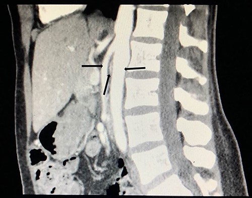 Computed tomography angiogram on presentation, sagittal view showing origin of SMA (left arrow) and the aorta (right arrow) with the compressed LRV in the narrow angle (middle arrow).