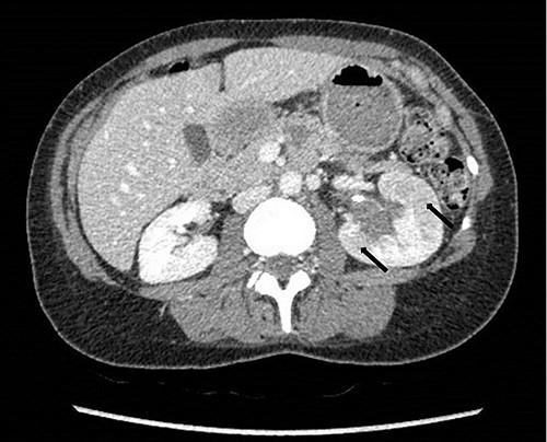 Computed tomography on presentation showing multifocal areas of hypoattenuation throughout the left renal cortex (arrows).